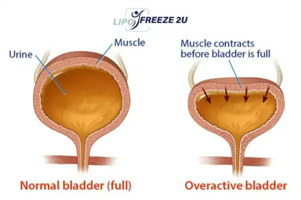 diagram of overactive bladder treatment Farnborough