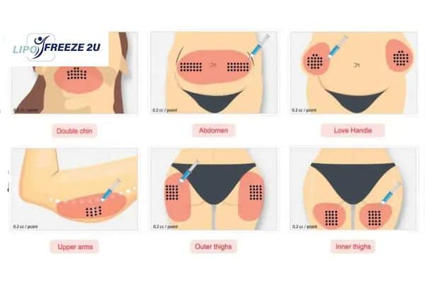 Benefits of Choosing Aqualyx for Fat Reduction Farnborough