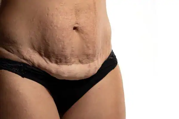 loose skin after weight loss injections Farnborough