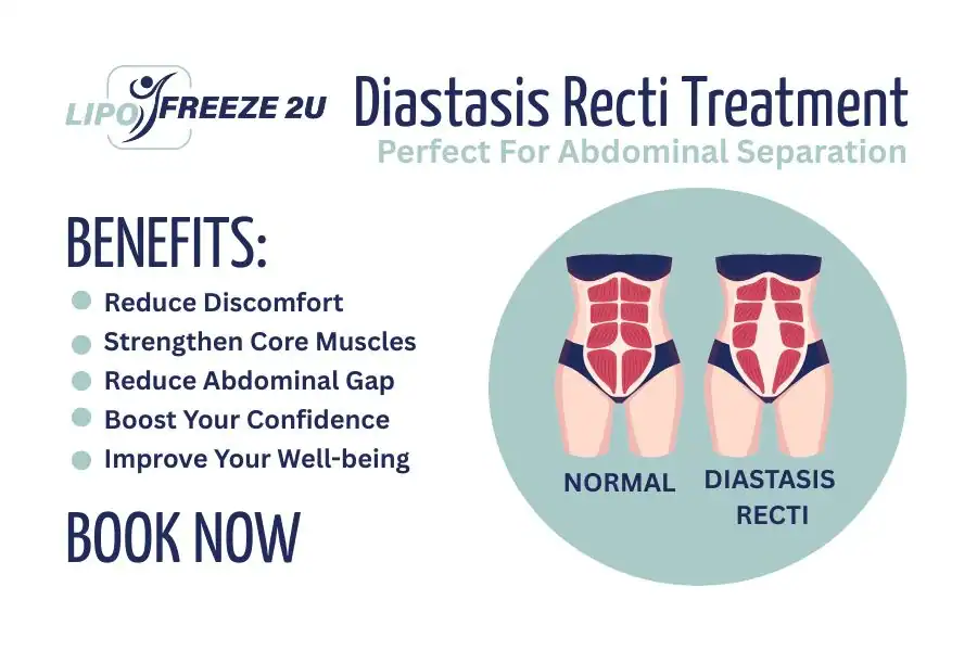 How Long Will It Take to See Improvements in Diastasis Recti Farnborough