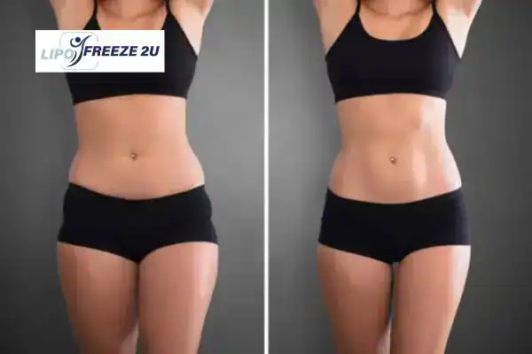 How Can LIPO FREEZE 2U Support Your Post-Pregnancy Body Recovery Farnborough?