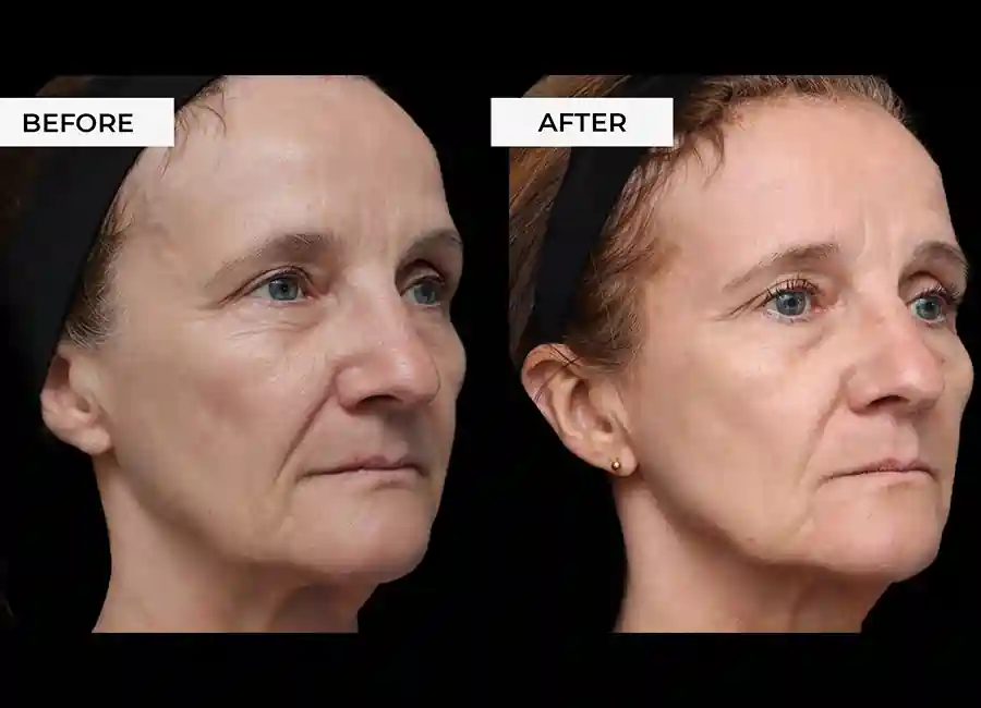 How Many RF Microneedling Sessions Will You Need to See a Difference Farnborough?